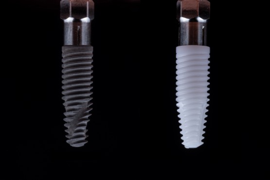 Implant Cyrkonowy - nowoczesne rozwiązanie w stomatologii.